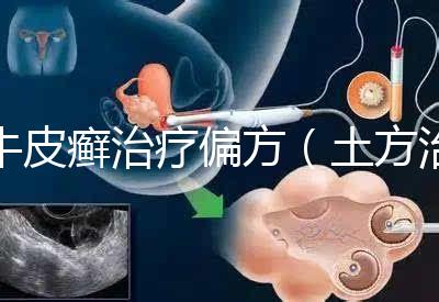 牛皮癬治療偏方（土方治牛皮癬）