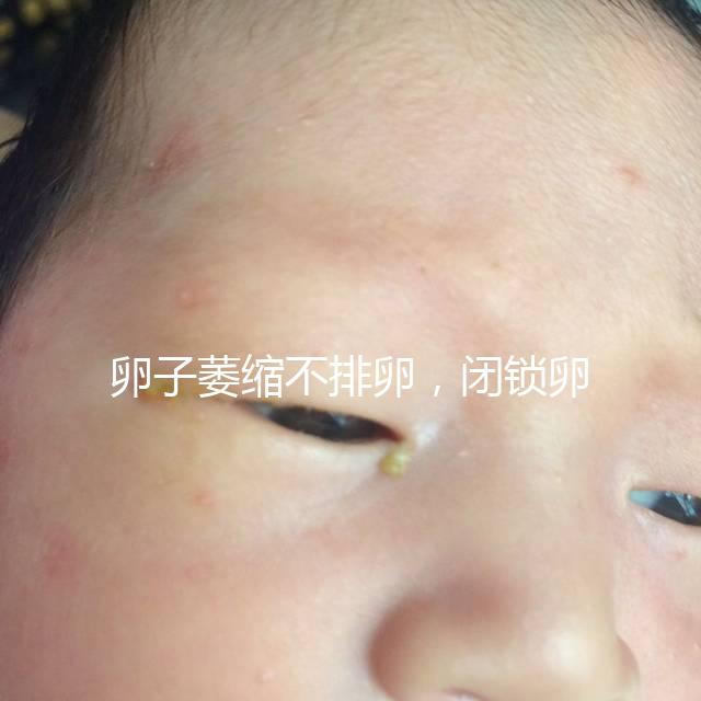 卵子萎縮不排卵，閉鎖卵泡形成原因與這4點(diǎn)有關(guān)