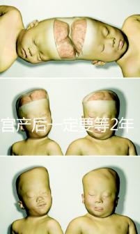 剖宮產(chǎn)后一定要等2年,才能試管嬰兒懷孕嗎?