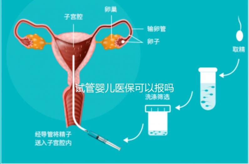 試管嬰兒醫(yī)?？梢詧?bào)嗎