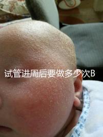 試管進周后要做多少次B超？需要檢查什么？進來看看