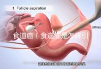 食道癌(食道瘤是怎樣引起的)